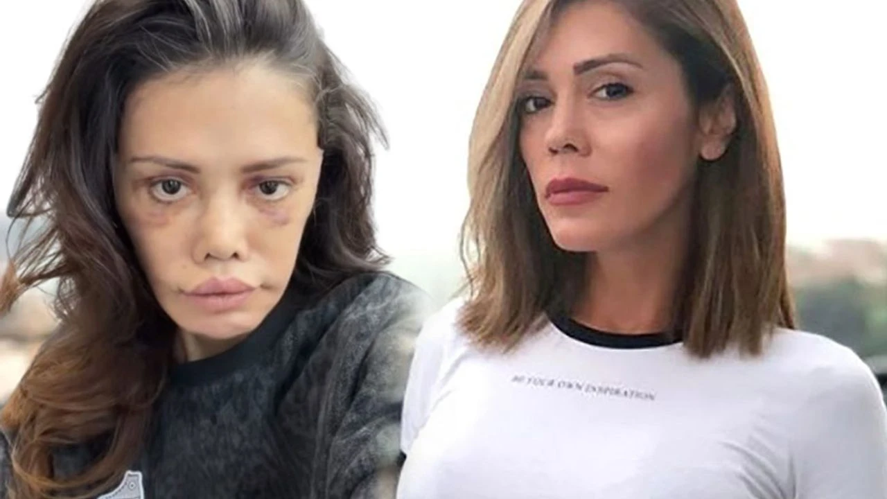 Didem Ceran kimdir, neden yüz nakli oldu? Didem Ceran kaç yaşında, aslen nereli, mesleği nedir?